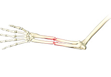 Adult Forearm Fractures