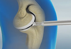 Arthroscopic Debridement of the Elbow