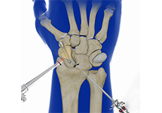 Arthroscopic Partial Wrist Fusion