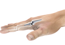 Artificial Finger Joint Replacement