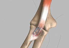 Biceps Tendon Repair