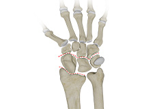 Carpal Instability