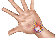 Carpal Tunnel Syndrome