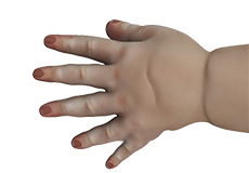 Congenital Hand Anomalies
