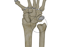 Distal Radioulnar Joint (DRUJ) Instability