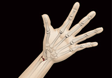 Distal Radius Fracture