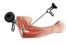 Elbow Arthroscopy