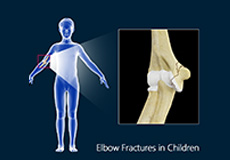 Elbow Fractures in Children