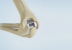 Total Elbow Replacement