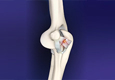 Elbow Ligament Injuries