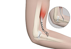 Elbow Tendon and Ligament Repair