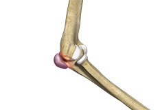 Elbow Trauma