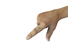 Finger Fractures