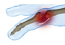 Finger Joint Dislocation & Volar Plate Injury