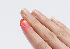 Fingertip Injuries