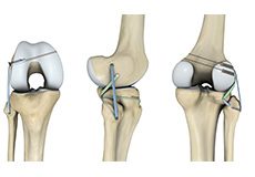 Ligament Preservation/Repair