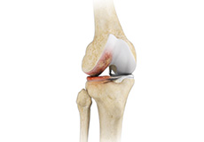 Osteoarthritis Management