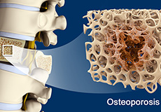 Osteoporosis and Fall Prevention