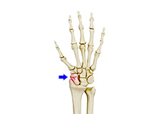 Scaphoid Fracture