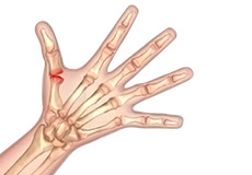 Surgery for Thumb and Digit Arthritis