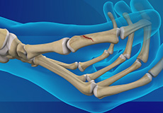 Thumb Fracture