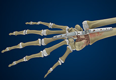 Total Wrist Arthrodesis