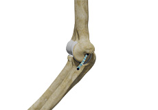 Ulnar Collateral Ligament (UCL) Repair with Internal Brace