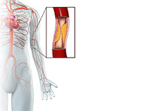 Upper Limb (Arm) Artery Disease