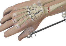 Wrist Fracture Fixation