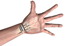 Wrist Joint Replacement