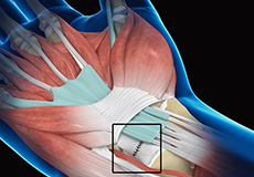 Ligament Reconstruction