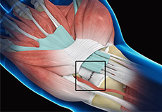 Wrist Ligament Reconstruction